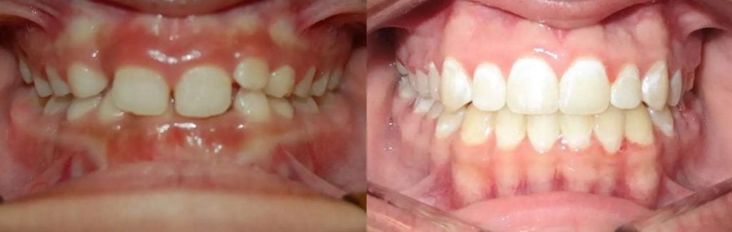 Zahnspange Überbiss vorher-nachher-Fotos