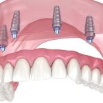 61688Prothese für einen Zahn: Fehlende Zähne ersetzen mit Einzelzahnprothesen