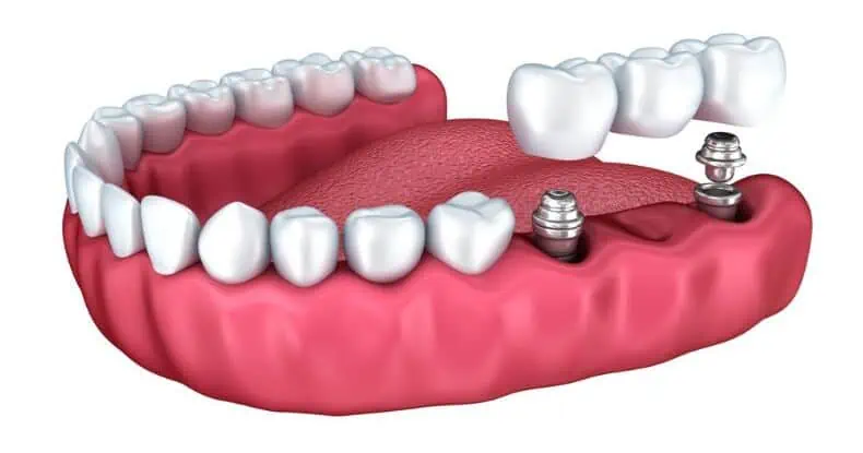 Implantatgetragene Brücke