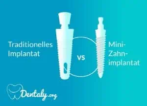 Mini-Implantat bei Osteoporose