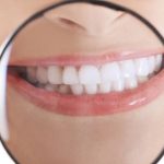 63960Keramikbrackets: Diskrete Zahnkorrektur mit der Keramik-Zahnspange