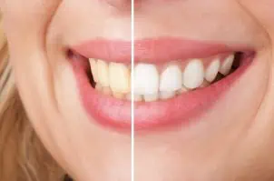 Vorher-Nachher-Bilder einer professionellen Zahnaufhellung, im Zusammenhang mit einem Artikel über Whitening-Mundspülungen.