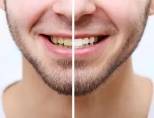 wann zähne aufhellen