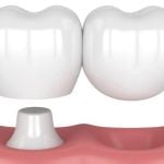 73230Zirkon oder Titan Zahnimplantate: Welches ist die bessere Option?