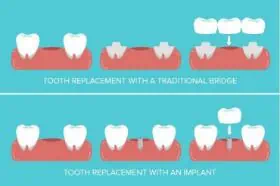 Zahnbrücke vs Implantat