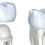 73330Greift die Zahnzusatzversicherung, wenn schon Zähne fehlen?