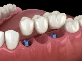 3 Zähne auf 2 Implantaten