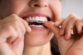 suresmile kosten