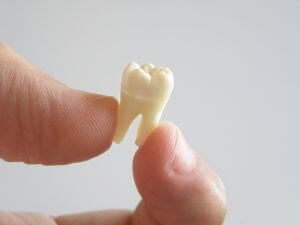 extracted tooth picture