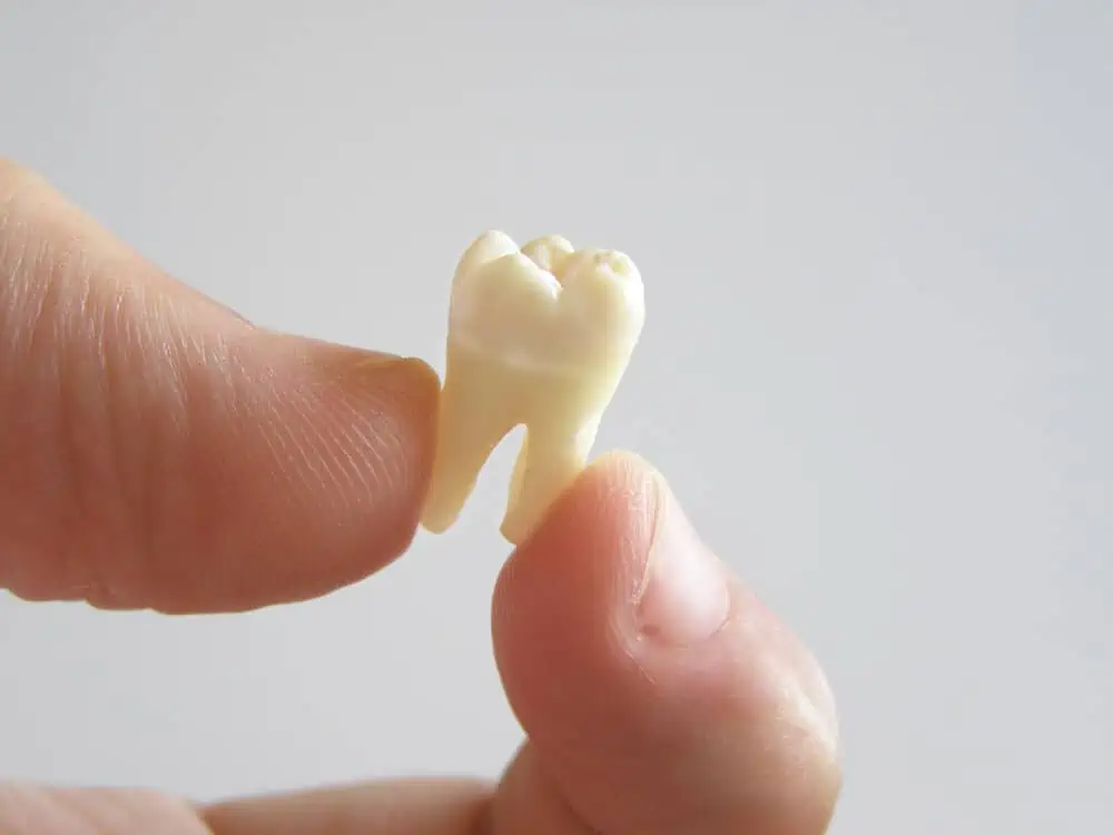 Tooth Extraction Procedure, Costs, Healing & Pain Relief