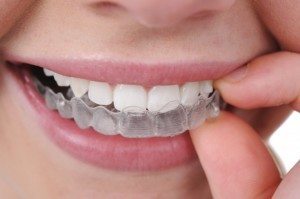 invisalign overbite