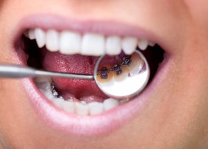 teeth straightening cost uk