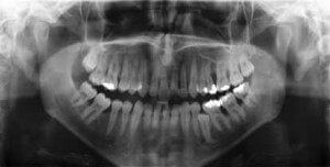 wisdom teeth x-ray