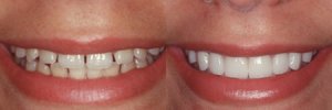 get veneers on finance