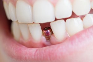 single tooth implant cost