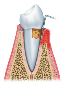 inflamed gums