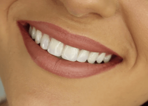 how much does a full set of veneers cost?