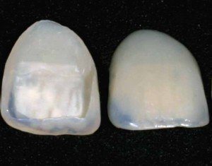 porcelain tooth covers