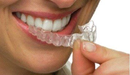 L'orthodontie par syst?me de goutti?re