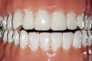 teeth with invisible aligner braces