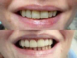 dental veneers before and after