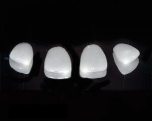 porcelain veneers lumineers