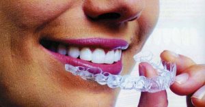 invisalign offers london