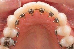 braces inside teeth