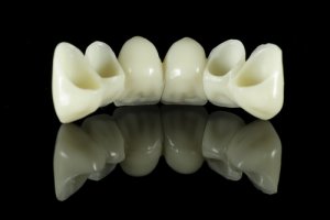 6 unit dental bridge for front teeth