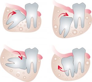 impacted wisdom tooth pain