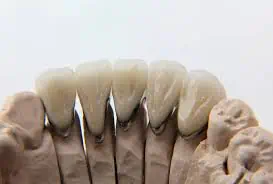 porcelain fused to metal crowns