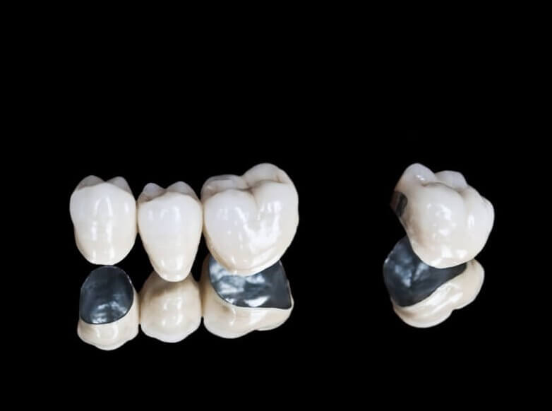 Ponte dentale Costi, tipi e altro (UK Tooth Bridge Guide) | Lost World