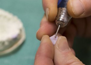 fitting a crown on teeth