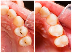 composite tooth filling photo