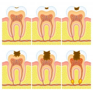 dental caries stages