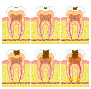 dental caries stages