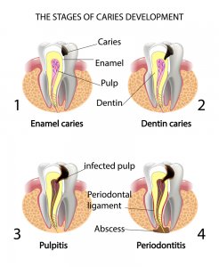 tooth decay stages