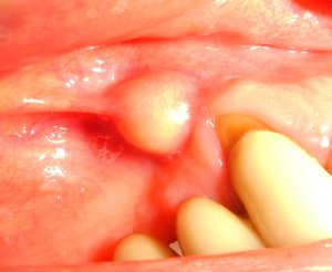 gum abscess picture