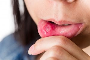 large ulcer on lips