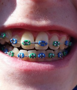 colours on metal braces