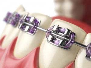 braces with bands