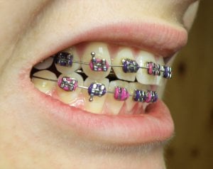 Why do braces hurt? 