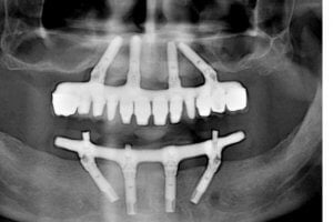 x-ray of teeth implants
