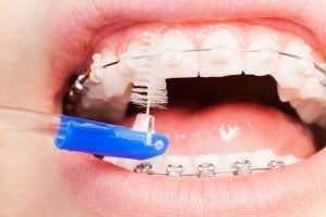cleaning ceramic braces stains