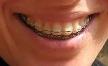 braces to match teeth