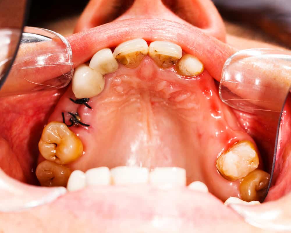 Tooth Extraction Procedure, Costs, Healing & Pain Relief