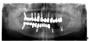 sinus dental implants