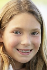 clear braces for kids