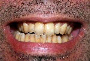 plaque stained teeth