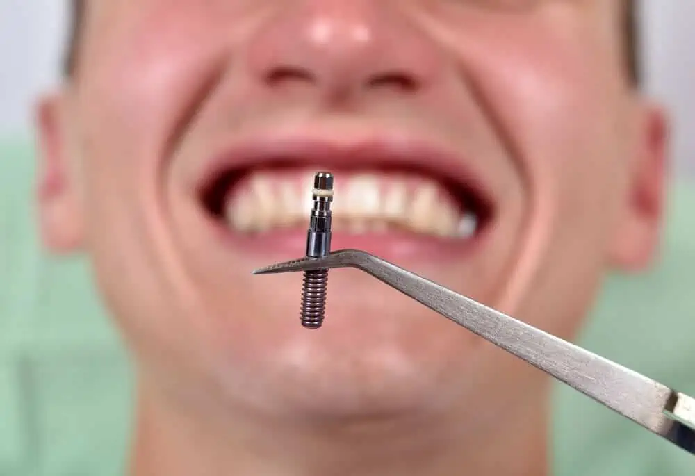 Dental Implants in the Philippines Costs, Risks & More